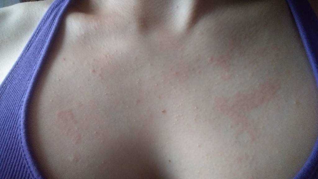 Высыпания на коже у детей – 35 распространённых заболеваний