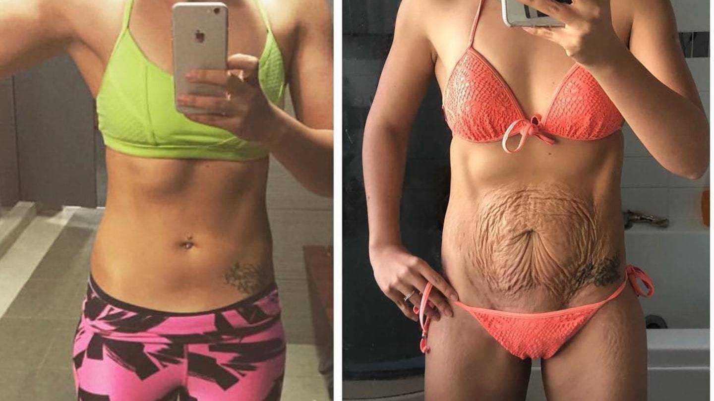 Целлюлит во время беременности – избавиться легко (без вреда для плода)