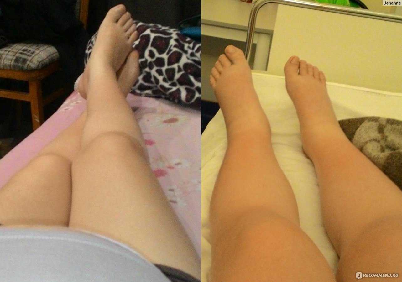 Почему увеличивается размер ноги после родов?