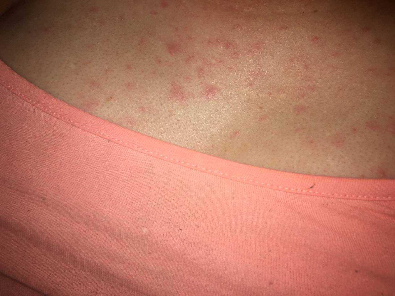 Зуд без сыпи: возможные причины, лечение | food and health