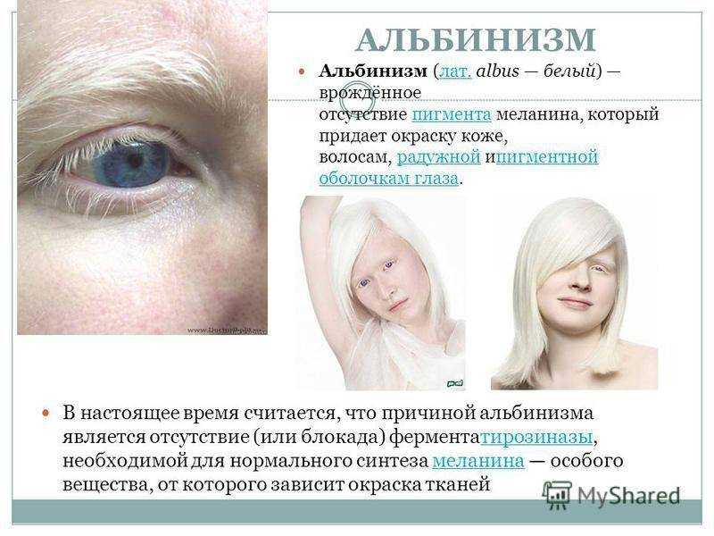 Альбинизм у человека: что это такое, симптомы, лечение, причины