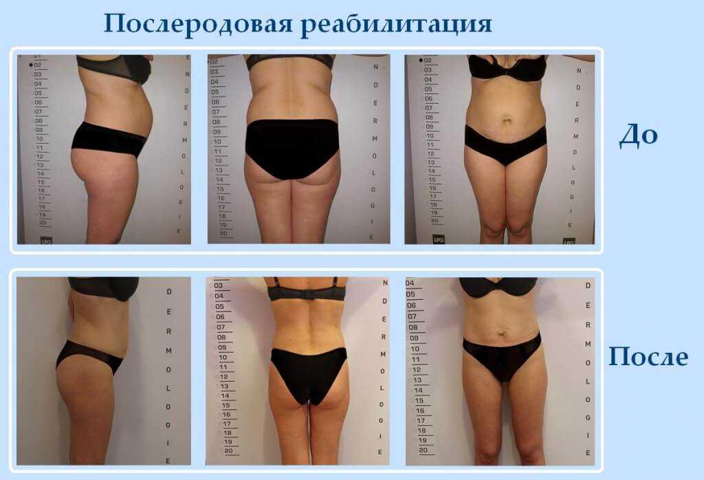 Отеки после родов: причины и лечение | статьи от центра флебологии