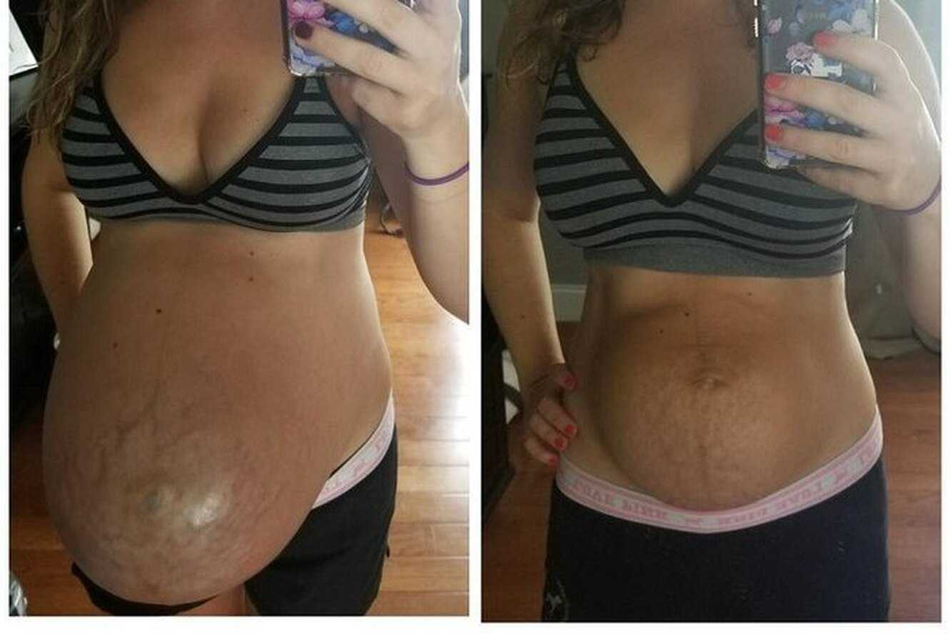 Может ли увеличиться размер ноги после родов