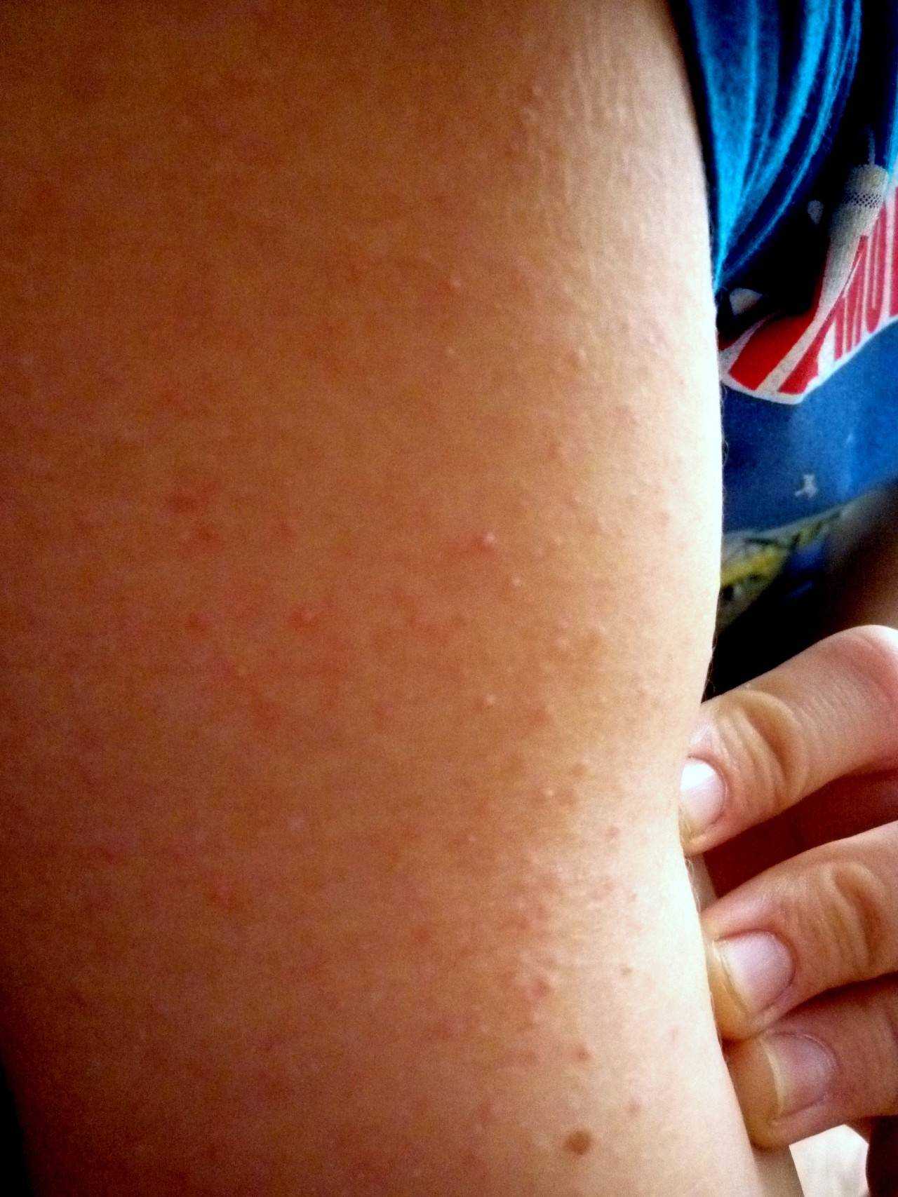 Кожный зуд у детей