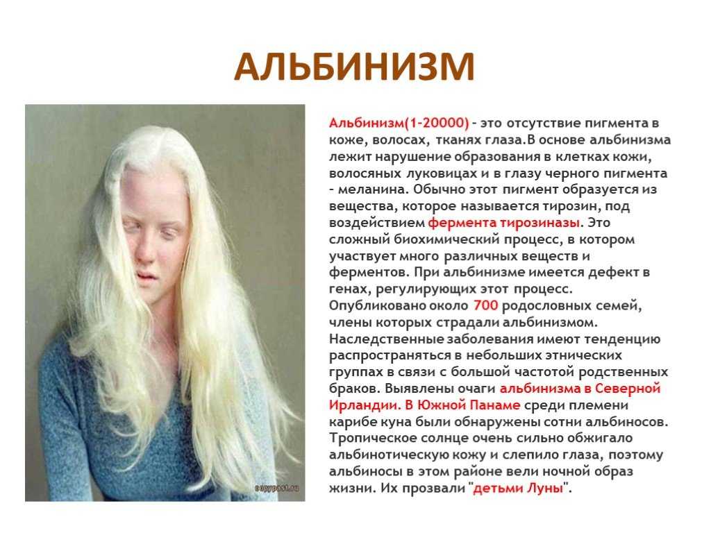 Альбинизм: почему ученые до сих пор не могут объяснить этот феномен - тестостерон