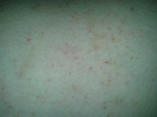 Зуд (чешется кожа)