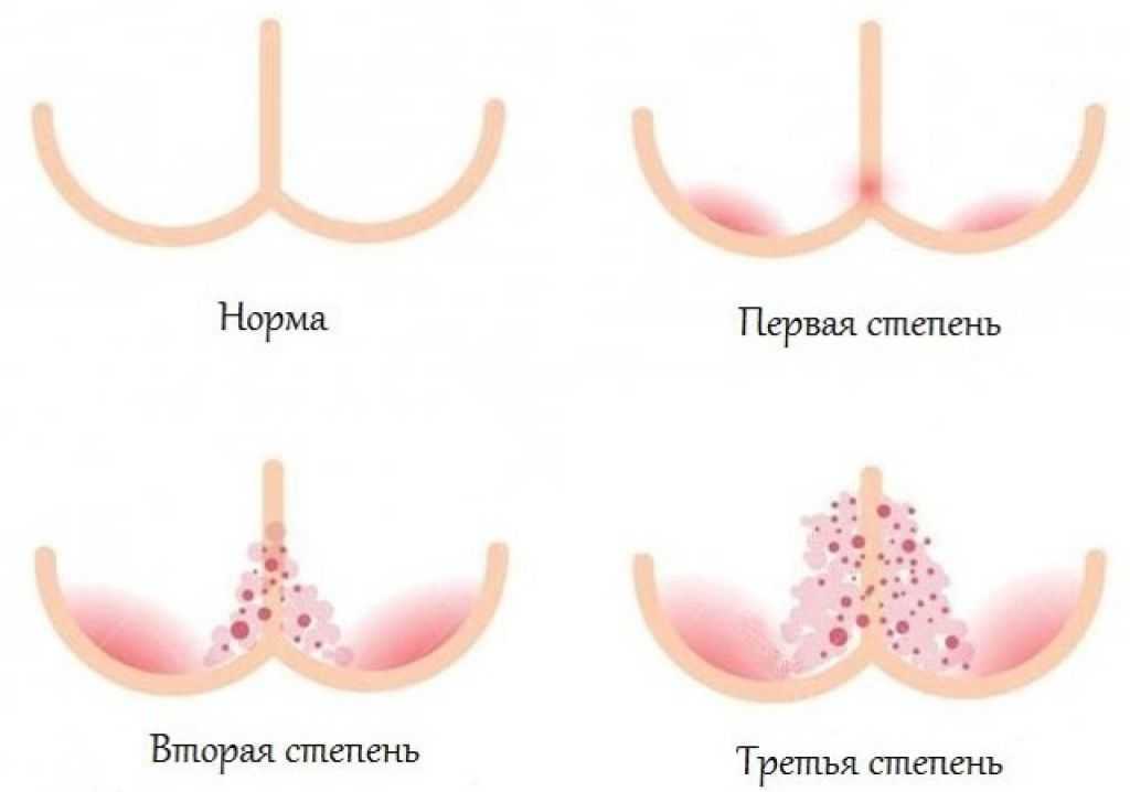 Чем снять кожный зуд у ребенка. кожный зуд у детей