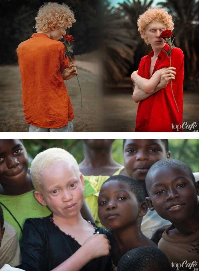 Дети-альбиносы. в чём причина и как проявляется заболевание?