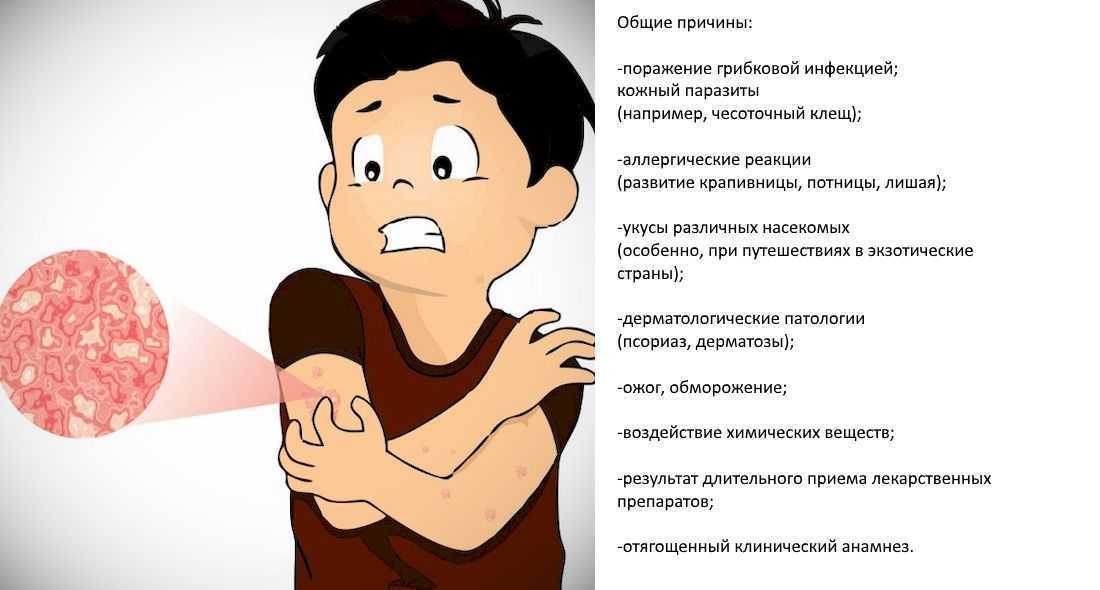 Аллергия у детей – виды, причины, симптомы и эффективное лечение