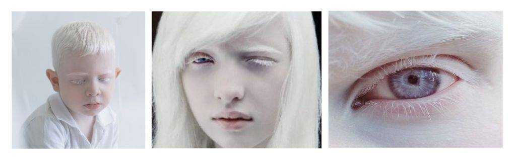 Люди-альбиносы: как выглядят и где живут, опасен ли альбинизм? - полисмед