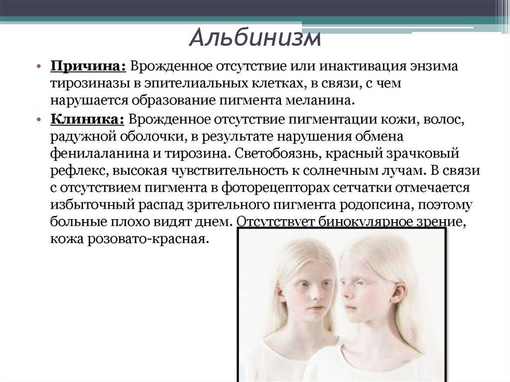 Люди-альбиносы: как выглядят и где живут, опасен ли альбинизм?