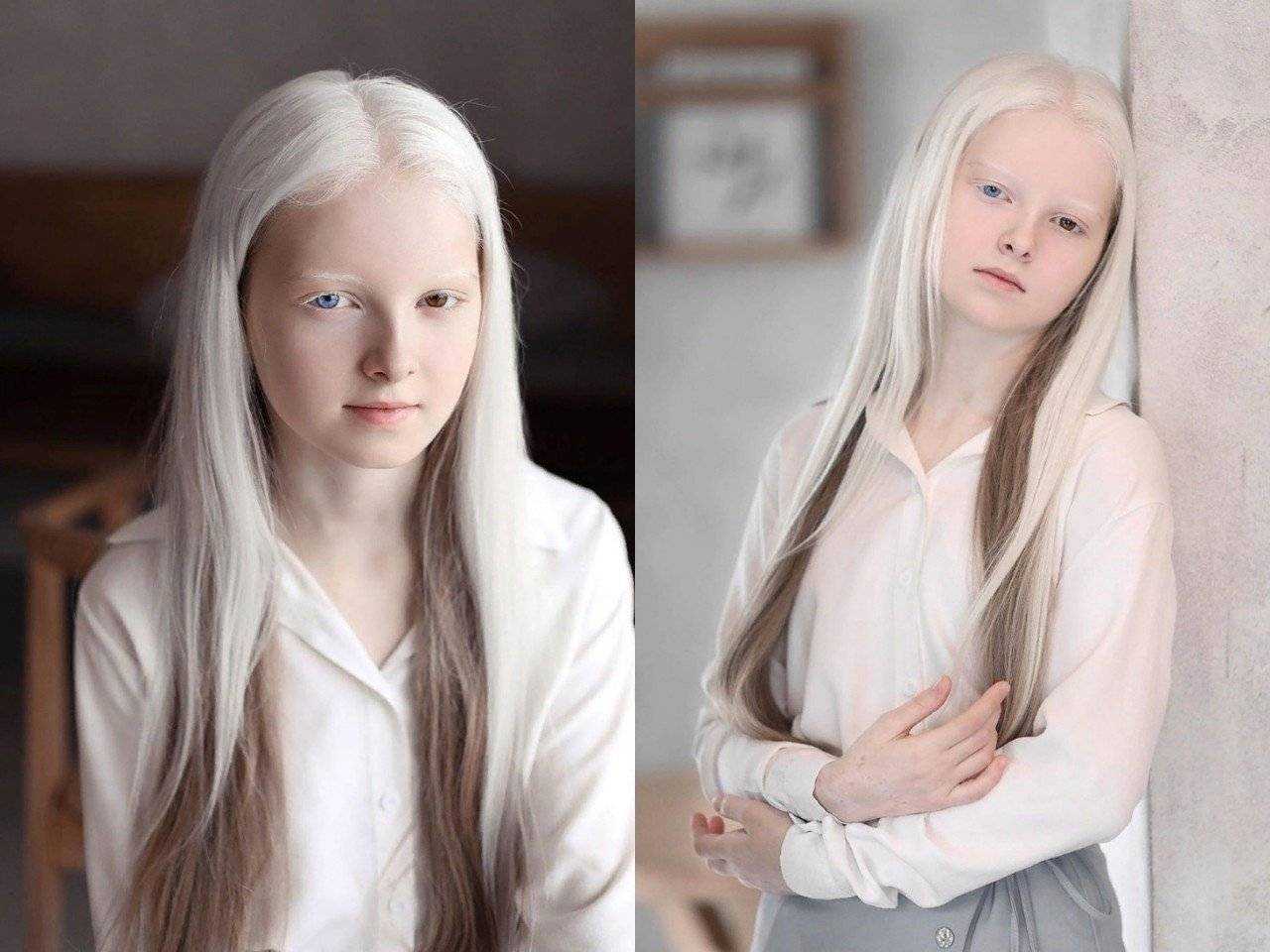 Люди альбиносы: фотографии и интересные факты