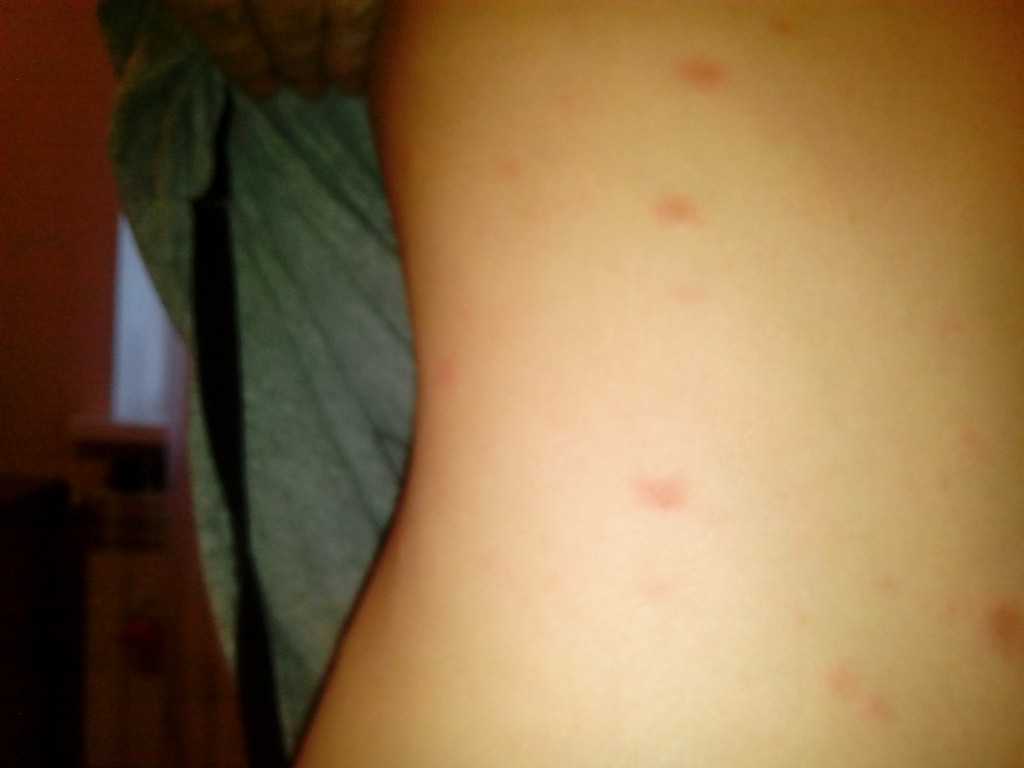 Ребенок постоянно чешется высыпаний нет