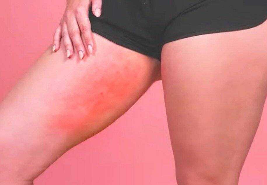 Чешется кожа на бедрах без высыпаний. почему ребенок чешется