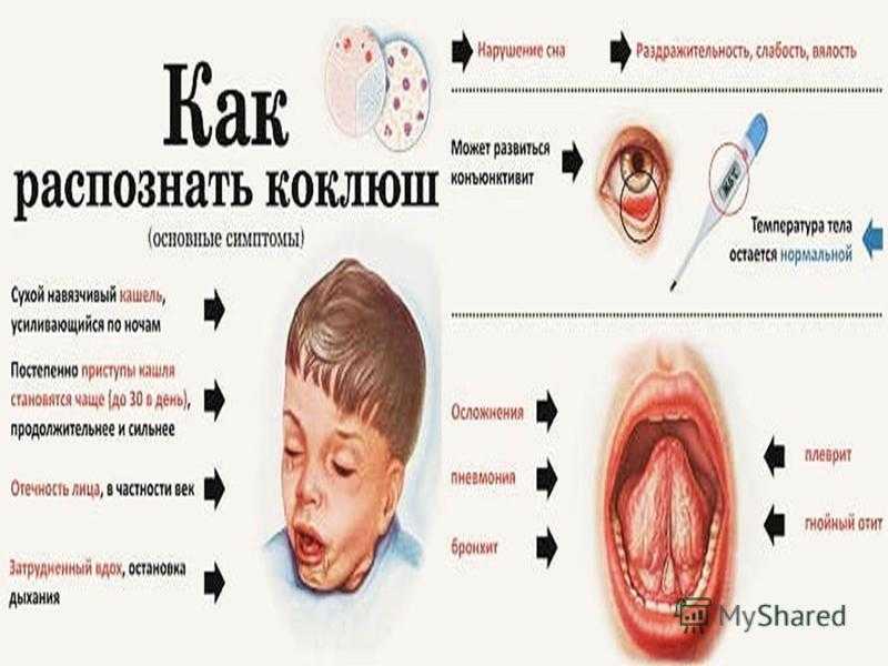Коклюш: что это, симптомы у детей и взрослых, лечение, причины и последствия
