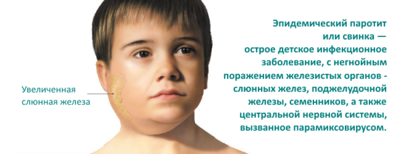 Свинка у детей: симптомы, виды, диагностика, лечение, осложнения паротита