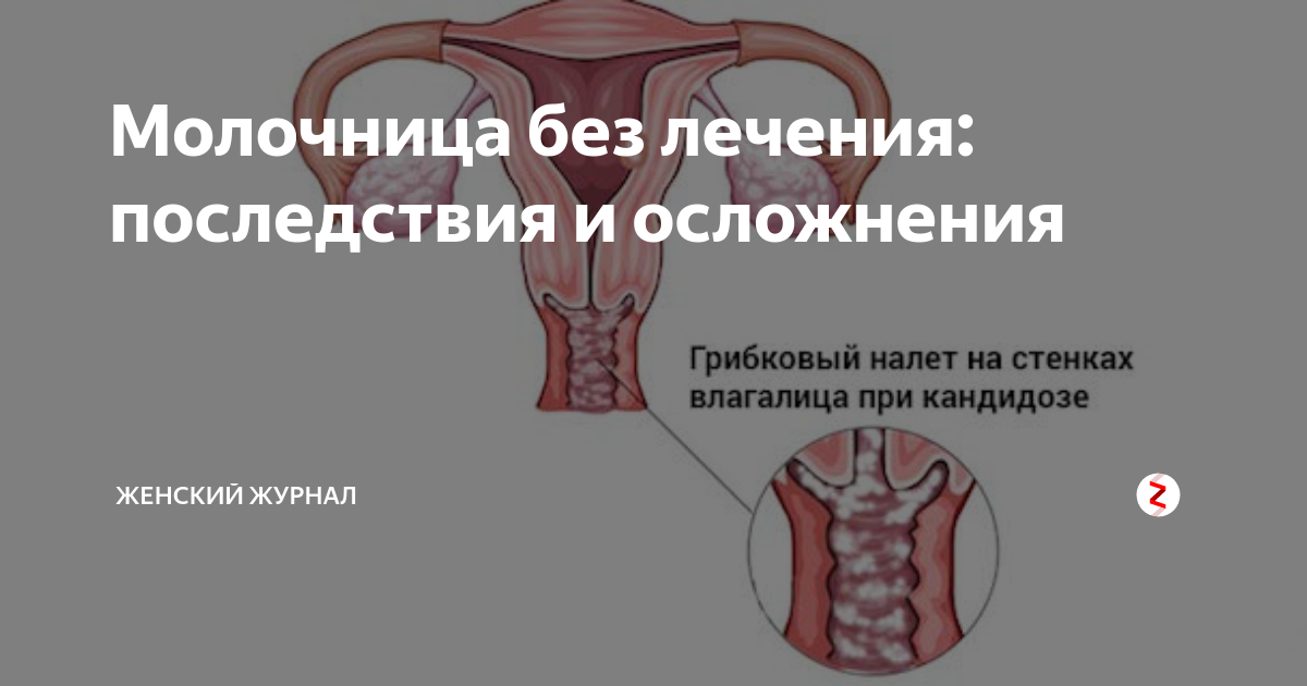 Молочница у женщин: что это такое и чем она опасна?