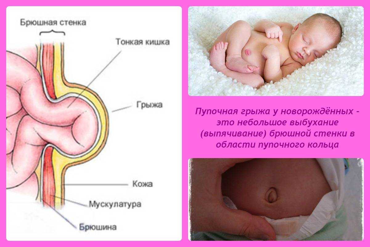 Паховая грыжа у детей: причины, симптомы и особенности лечения
