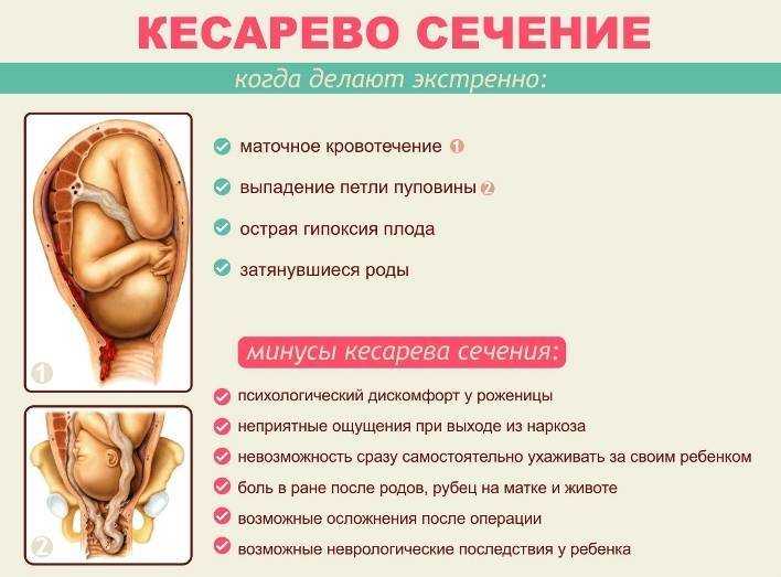 Кесарево сечение, мифы о кесаревом сечении  | гинекология.инфо
