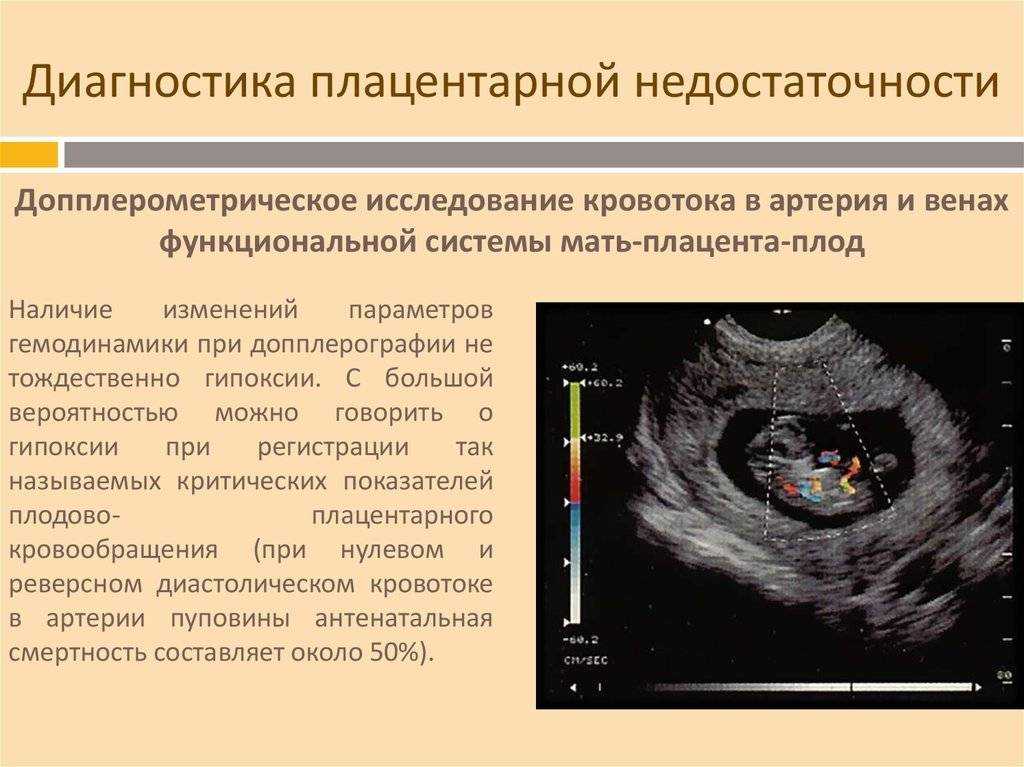Преждевременное созревание, старение плаценты на 20, 30, 31, 32, 33 неделе беременности