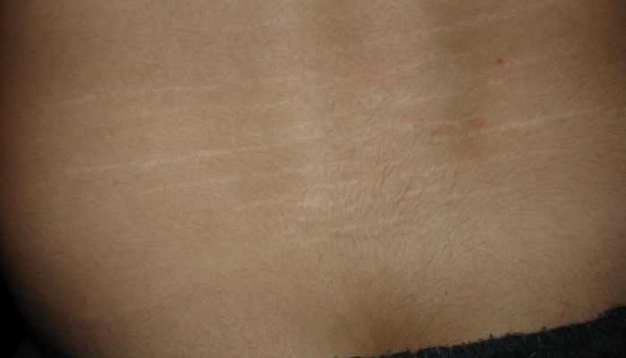 Почему появляются растяжки кожи у подростков - doctorplastik.com