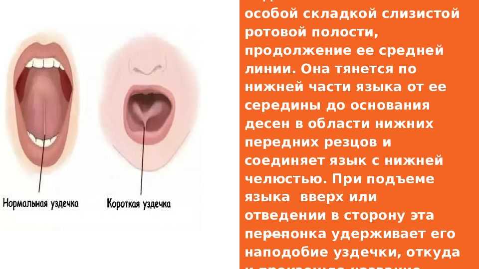 Как короткая уздечка может влияет на речь ребенка? | центр анны семкиной