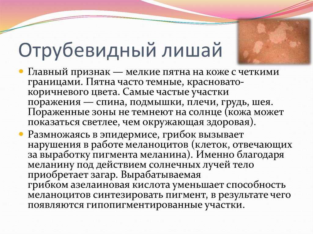 После отпуска на курорте можно заразиться разноцветным лишаем Читайте, по каким признаками его опознать, как лечить и чего делать не надо
