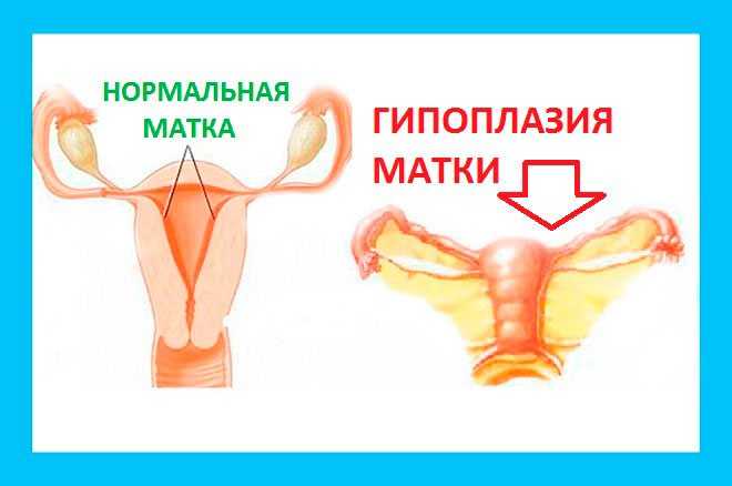 Гипоплазия матки: что это и можно ли забеременеть с такой патологией? * клиника диана в санкт-петербурге