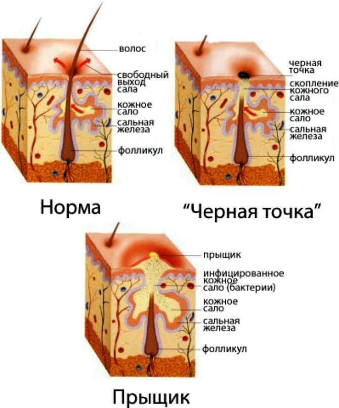 Почему прыщ не должен лопаться? | типтар