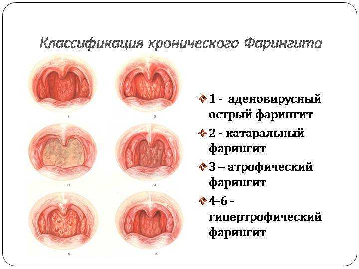 Ангина: что это такое, её причины и виды, возбудители, симптомы и признаки, как выглядит горло, как передаётся, заразна ли, сколько держится температура, осложнения