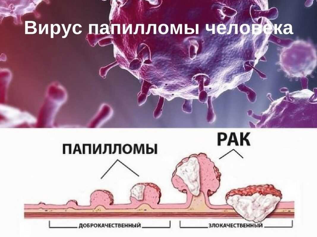 12 мифов про вирус папилломы человека