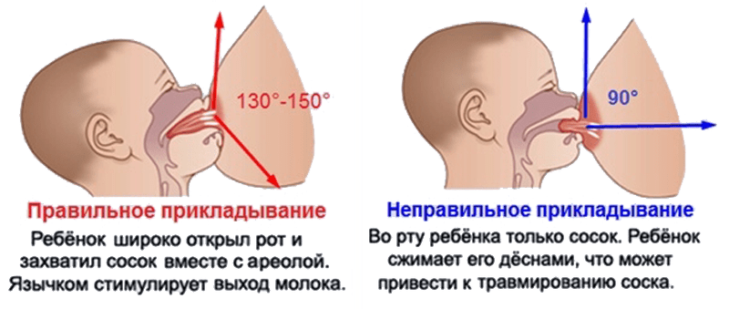 Болит грудь при грудном вскармливании: причины, симптомы, лечение