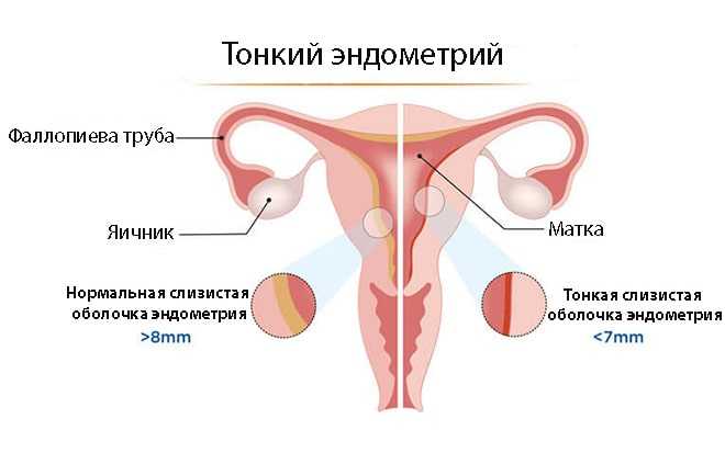 Гипоплазия матки: причины детской матки, как забеременеть