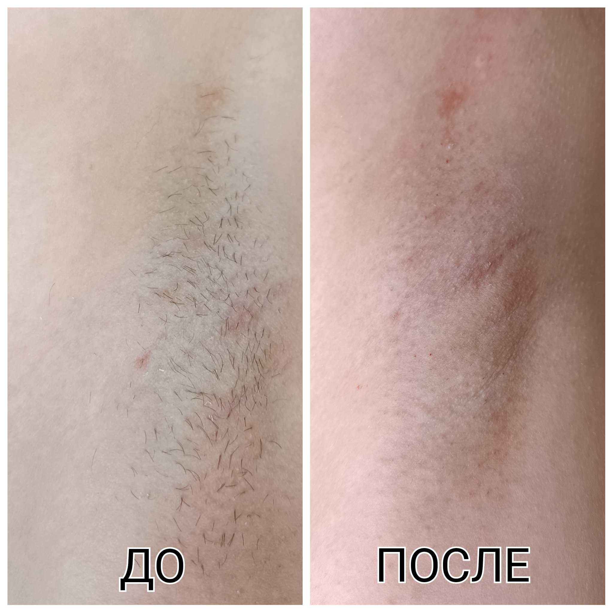 Избыточный рост волос (у девочек по мужскому типу): причины, диагностика и лечение