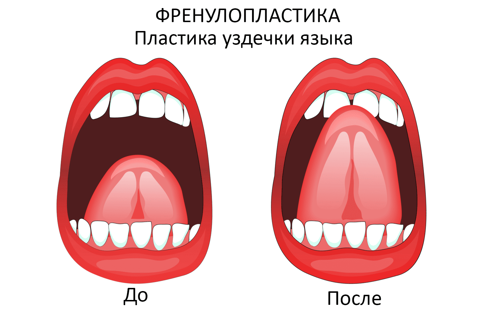 Уздечка языка: показания к операции, подрезание уздечки.