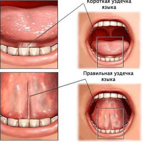 Пластика уздечки губы или языка. когда и как проводятся. вопросы к врачу.