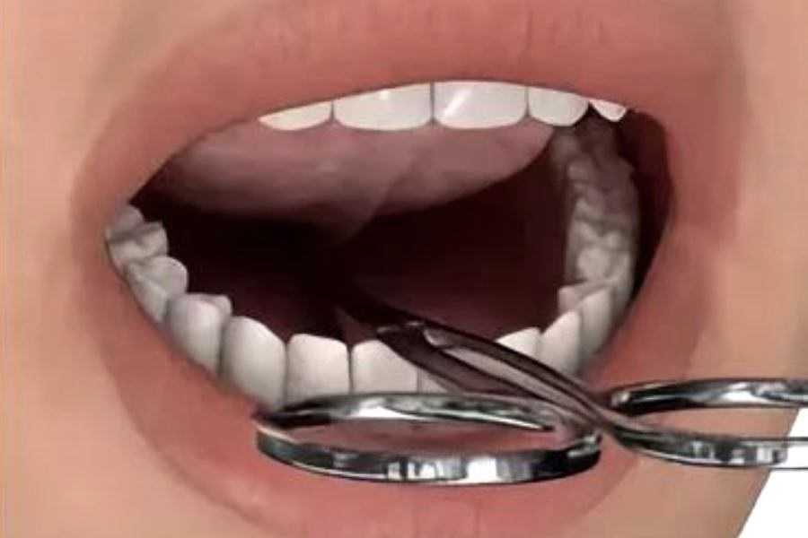 Подрезание уздечки под языком у детей: нужно ли, как определить короткую подъязычную уздечку у новорожденного