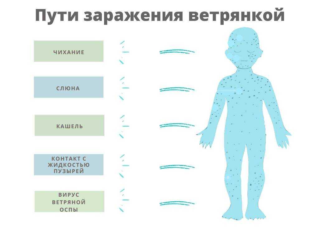 Прививка от ветрянки детям: когда ставить, её плюсы и минусы