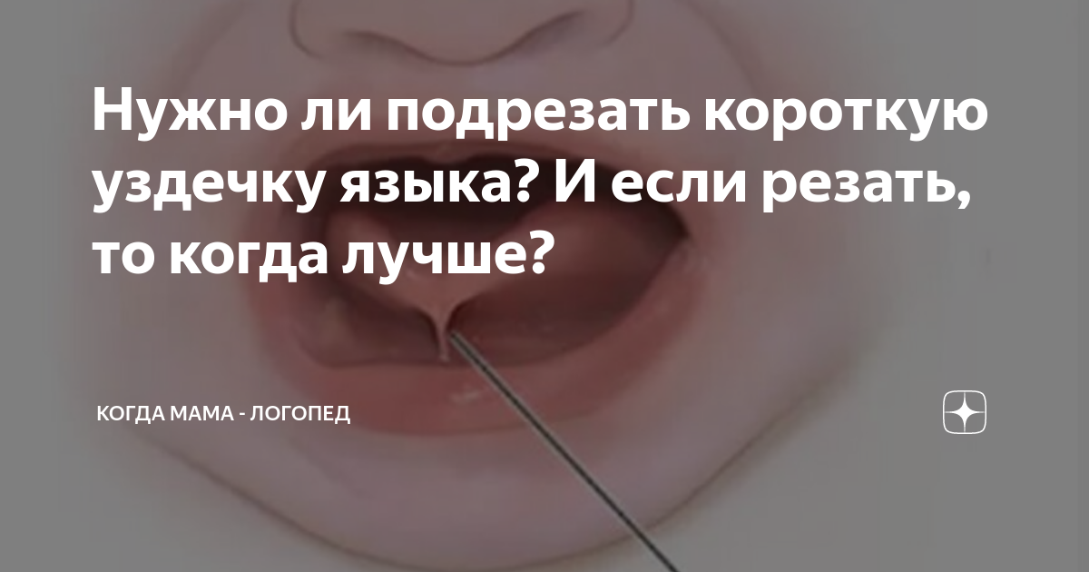 Подрезание уздечки под языком у детей и подростков