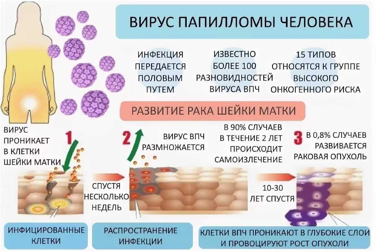 Впч и эрозия шейки матки: как связаны и как предотвратить