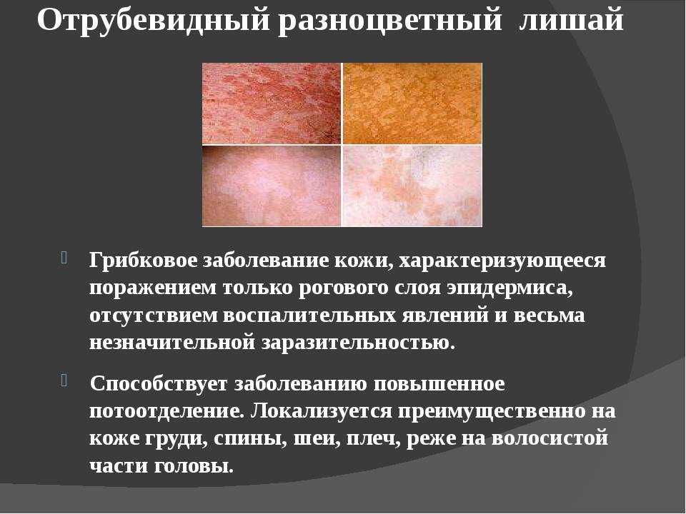 Заразен ли отрубевидный лишай, как передается разноцветная трихофития от человека к человеку
