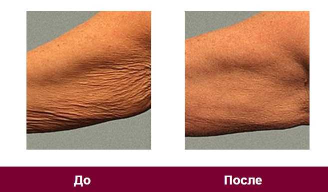 Почему кожа лица теряет упругость