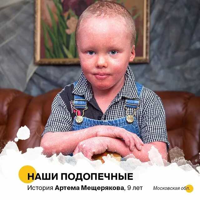 Буллезный эпидемолиз: причины и лечение врожденной болезни кожа бабочки