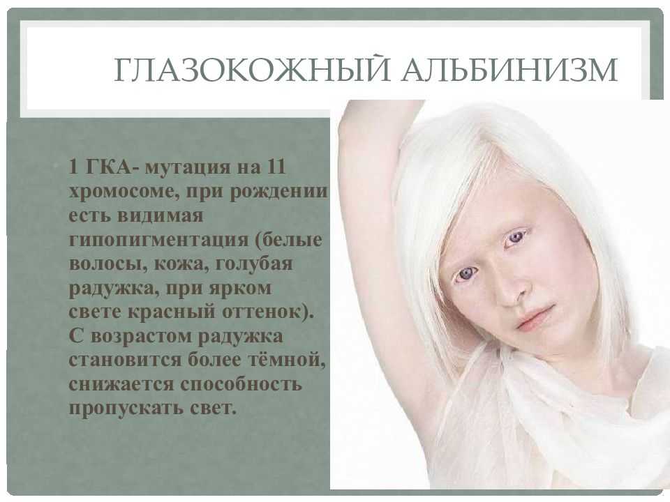 «альбиносы считают меня крашеной блондинкой». как живет девушка с диагнозом частичный альбинизм