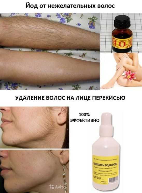 Как удалить волосы навсегда в домашних условиях