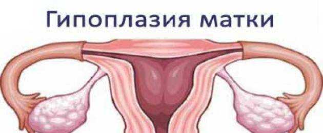 Гипоплазия матки: беременность и роды с детской маткой